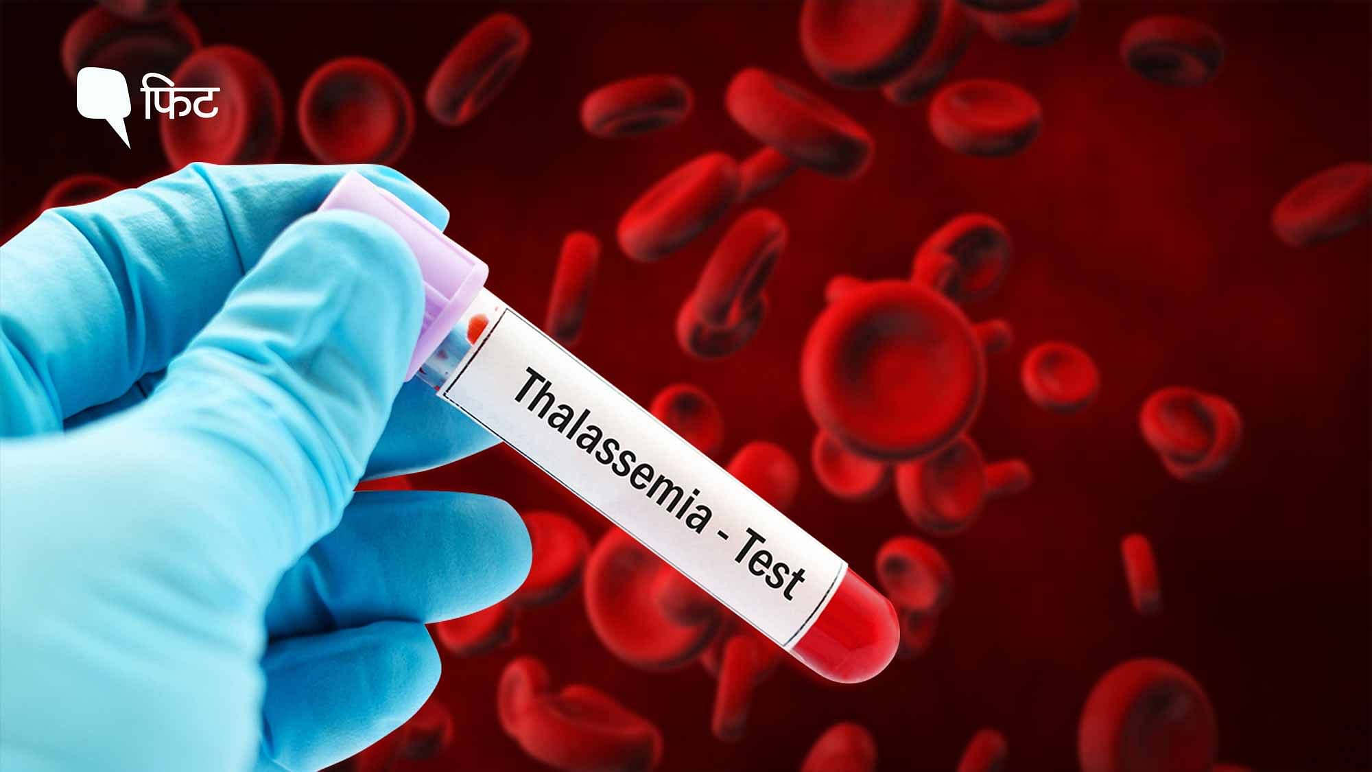 <div class="paragraphs"><p>World Thalassemia Day 202३| थैलेसीमिया, जिसमें खून में हीमोग्लोबिन बनना बंद हो जाता है. </p></div>