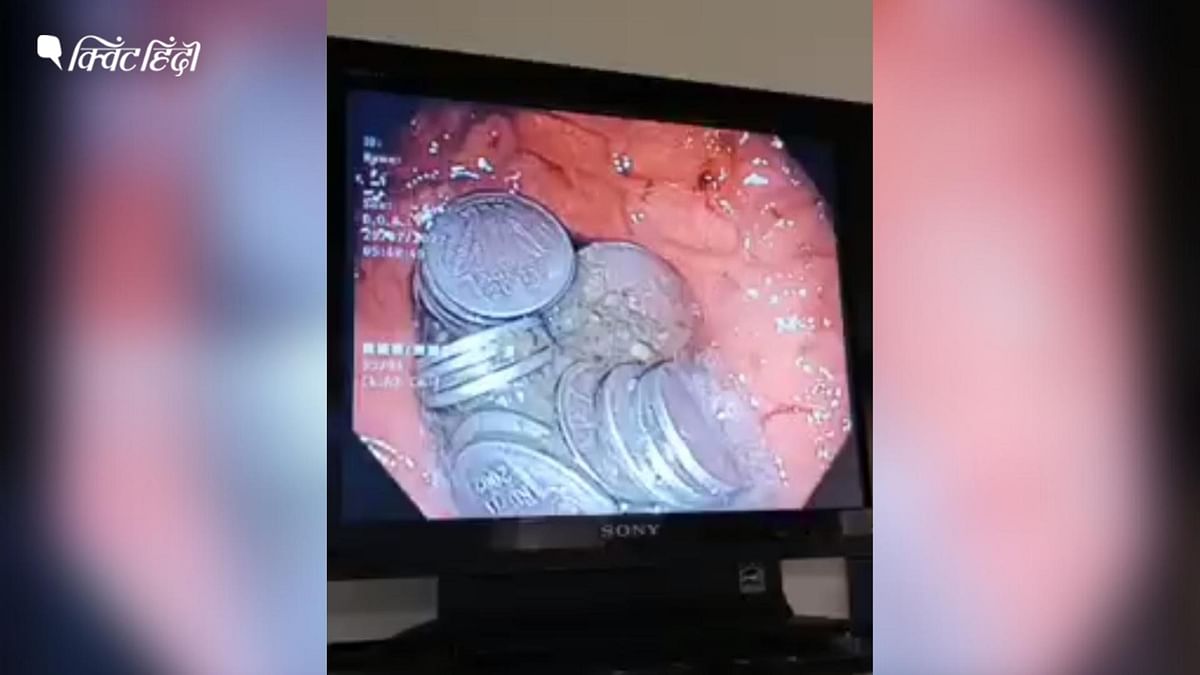 जोधपुर में एक शख्स के पेट से निकले 63 सिक्के, ढेर देखकर डॉक्टर्स भी हो गए हैरान
