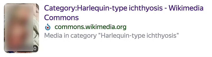 Harlequin Icthyosis त्वचा का एक बहुत दुर्लभ विकार है. जिसमें पूरे शरीर और चेहरे की त्वचा बहुत ज्यादा मोटी हो जाती है