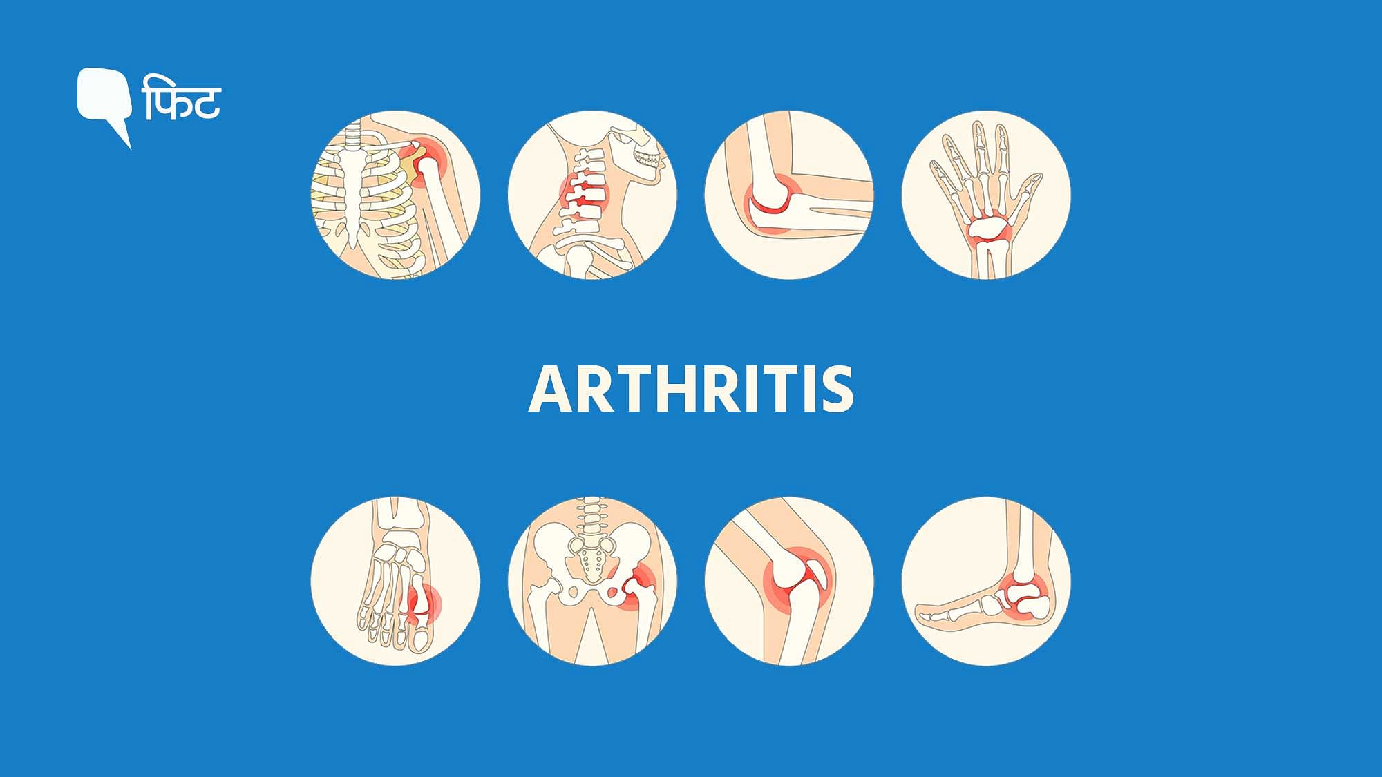 <div class="paragraphs"><p>World Arthritis Day:&nbsp;युवाओं में आर्थराइटिस की समस्या बढ़ रही है. ऐसे करें पहचान और इलाज.&nbsp;</p></div>