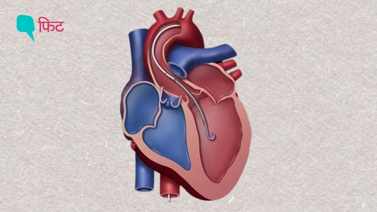 FAQ: इम्पेला डिवाइस क्या है? यह कैसे हृदय रोगियों की जान बचा रहा है?