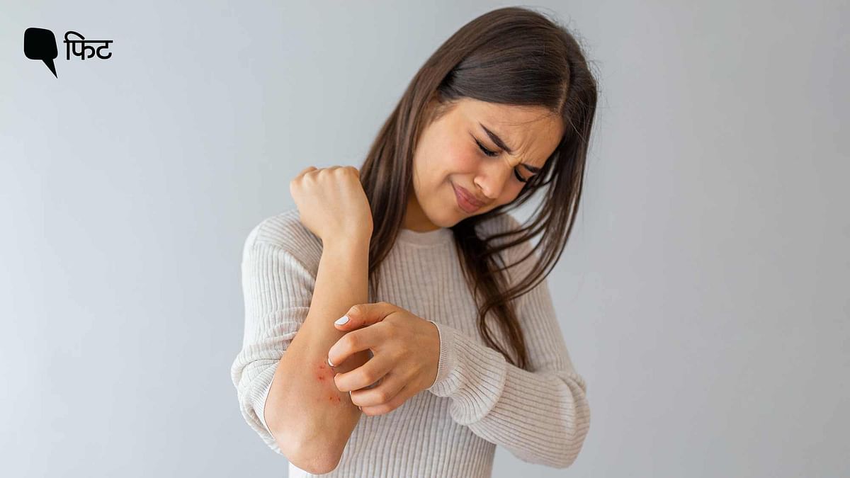 Atopic Eczema Day: एटोपिक एक्‍जिमा के ट्रिगर्स का ऐसे रखें ख्याल, एक्सपर्ट्स की राय