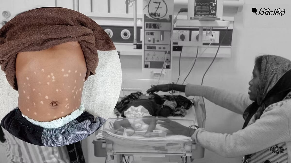 Madhya Pradesh Faith Healing Deaths गर्म सरिये से दाग कर बच्चों इलाज चमत्कार को नमस्कार करना