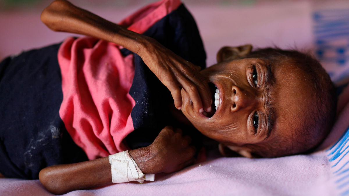 A malnourished child. Image used for representation only. <i>(Photo: Reuters)</i>