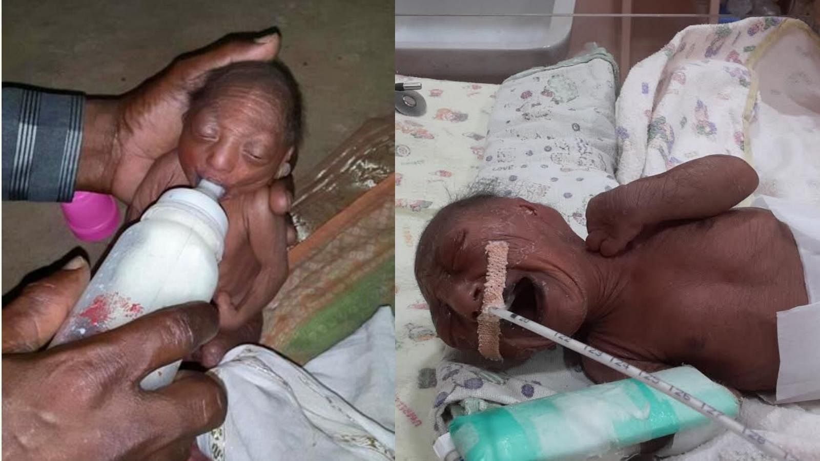 This rare medical condition might not shock you but what the parents of this three-week-old infant did will leave you in utter disbelief. (Photo: Wadia Hospital)