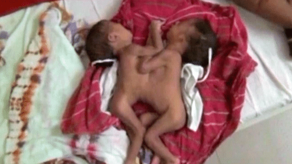 Conjoined twins in Jodhpur. (Photo: ANI screengrab)