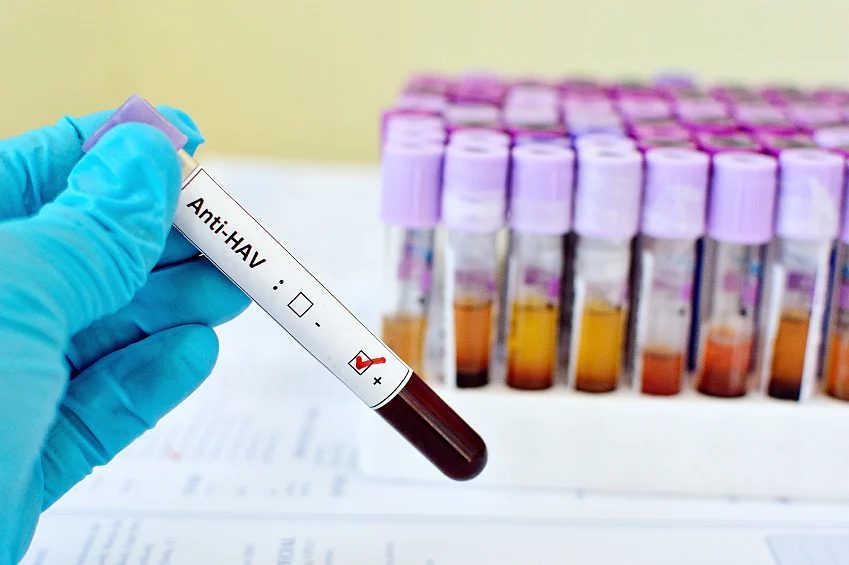 Hepatitis B is the most severe type of hepatitis; 4 out of 5 times if left untreated, chronic hepatitis B causes liver cancer or cirrhosis (Photo: iStock)