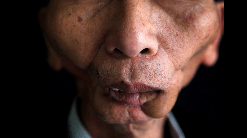 A patient of mouth cancer after brutal rounds of chemotherapy. It’s still your right to smoke and dirty up your lungs (Photo courtesy: Voice of Tobacco Victims)