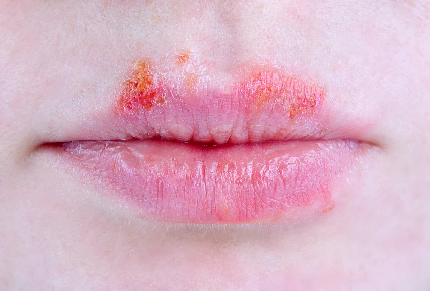 Herpes infection in the mouth. The fact that the disease is ‘incurable’, it remains in the body and can become active at any time, makes these numbers seem more frightening than they need to be. (Photo: iStock)