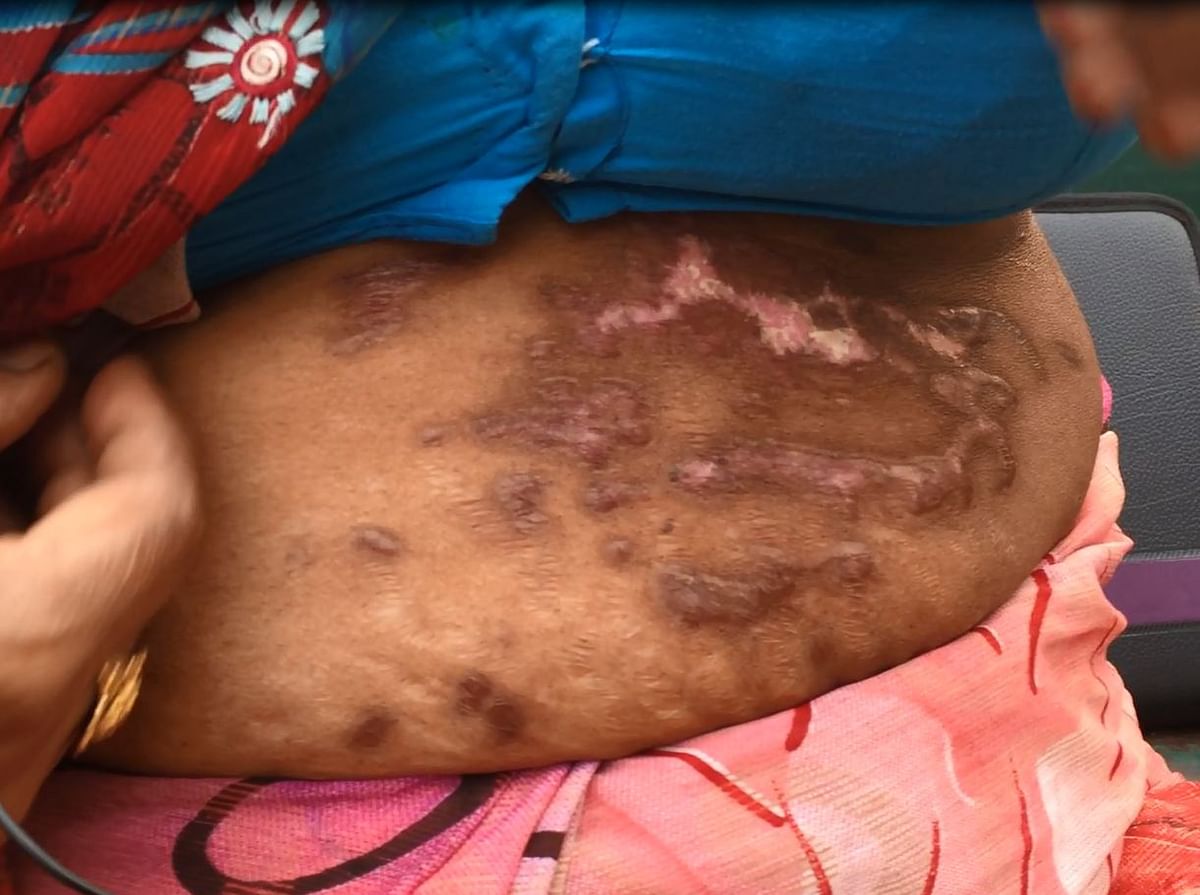 This couple and their 15-year-old daughter were all victims of a brutal acid attack.