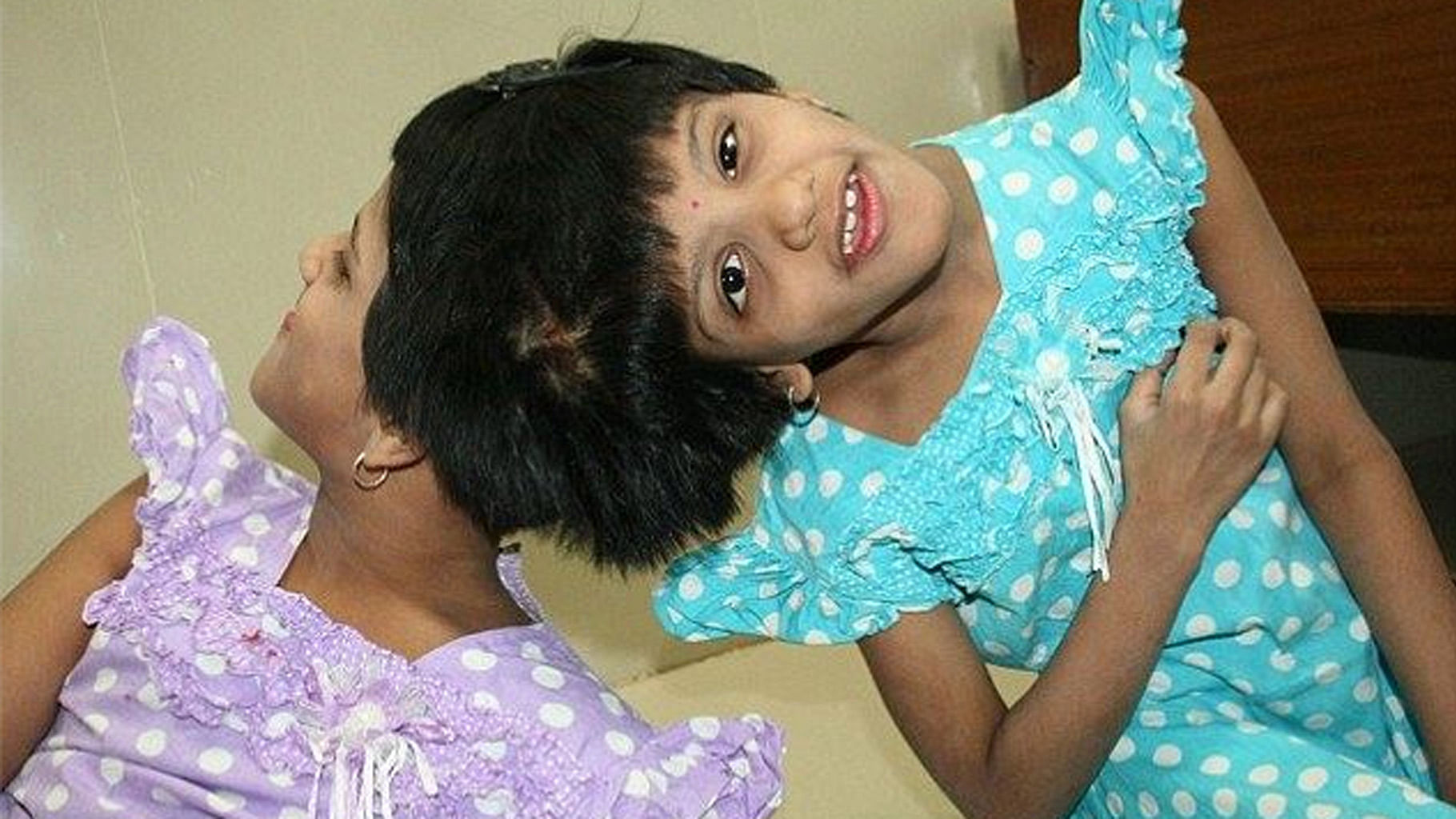 13-year-old conjoined twins Veena and Vani. (Courtesy: Facebook/ <a href="https://www.facebook.com/Veenavanitwins/photos/a.1427912737430863.1073741825.1427911764097627/1427912750764195/?type=3&amp;theater">VEENA-VANI conjoined twins</a>)