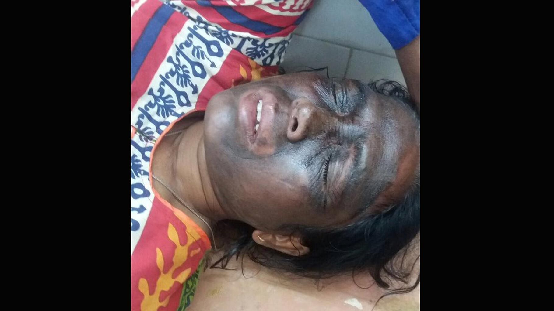 Soni Sori after being attacked. (Photo Courtesy: ANI)