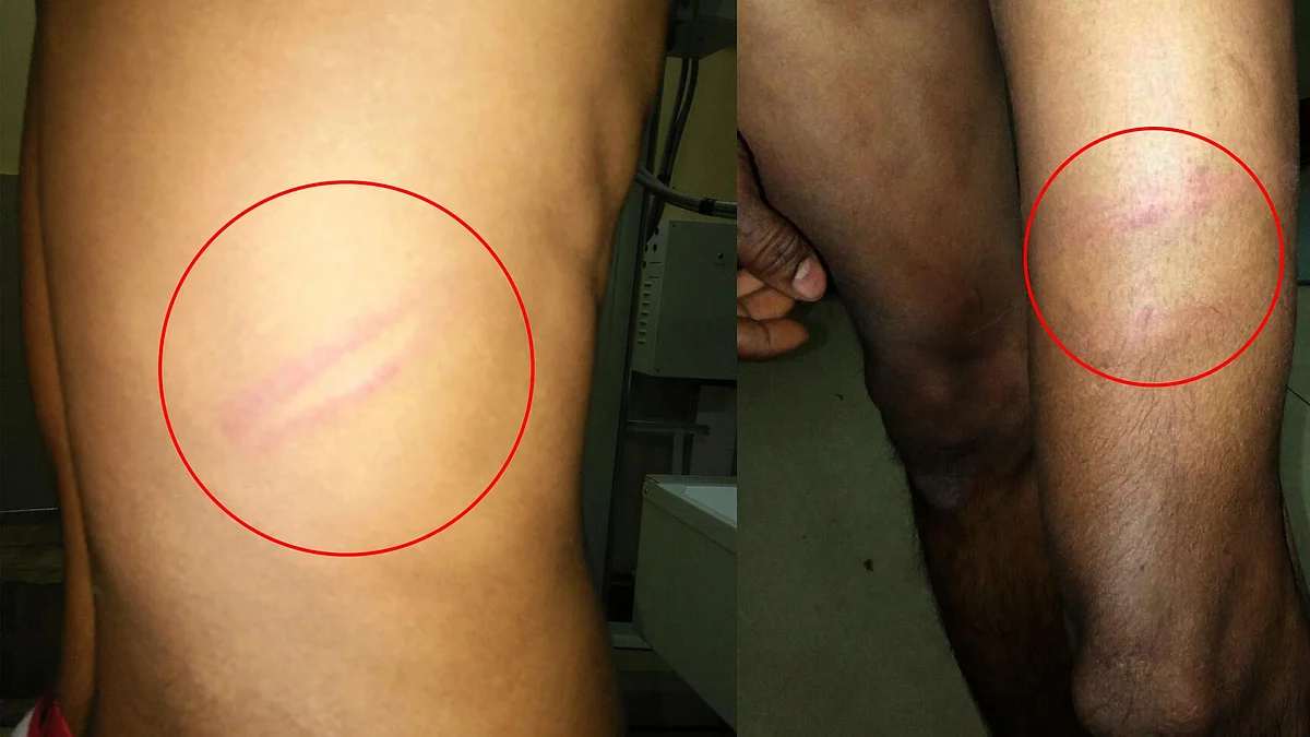 Wounds on Sadik’s back and legs following the alleged assault. (Photo Courtesy: Puja Changoiwala)