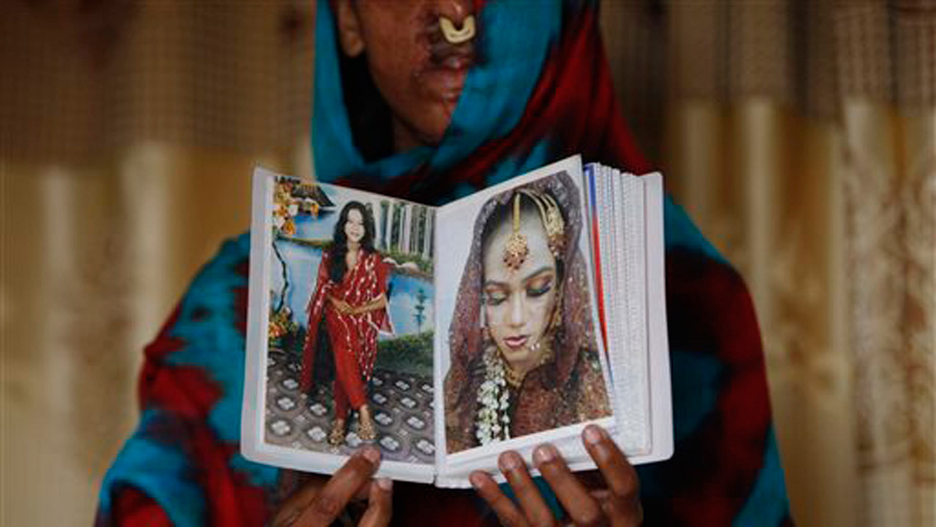 Sidra Kamwal shows pictures of herself before she was disfigured in an acid attack in Karachi, Pakistan. (Photo: AP)