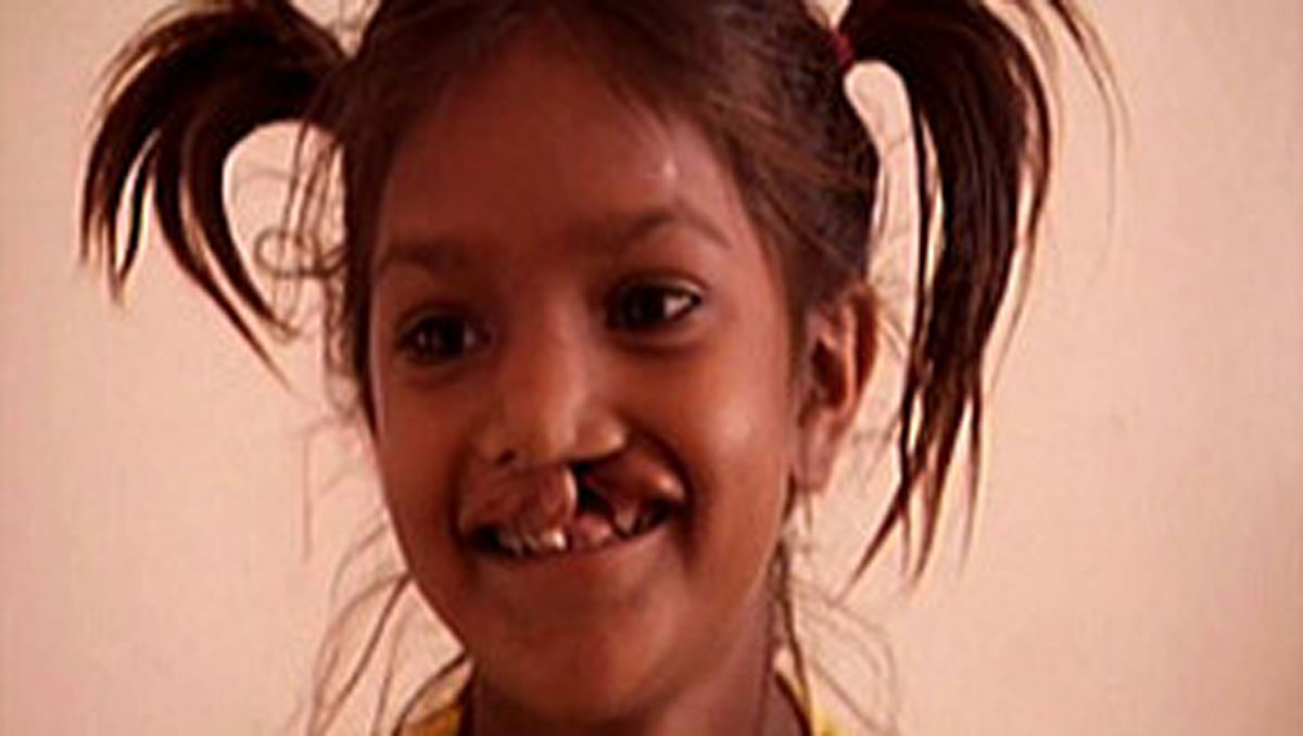 These adults and children had no idea their cleft lips could be cured, before Smile Train came along.
