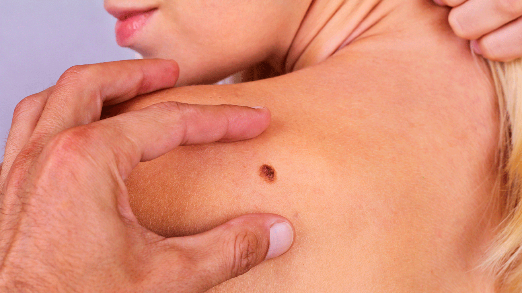 Melanoma occurs when the pigment-producing cells that give colour to the skin become cancerous. 