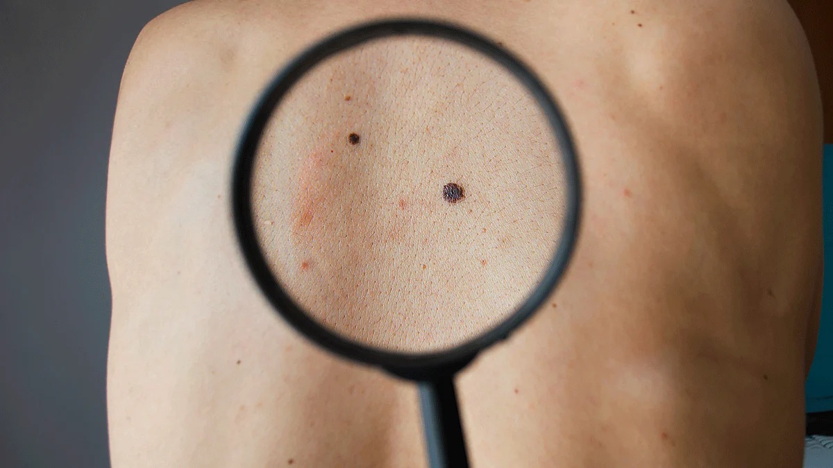 The discovery is significant because changing or irregular moles were only thought to be a key sign of melanoma (Photo: iStock)