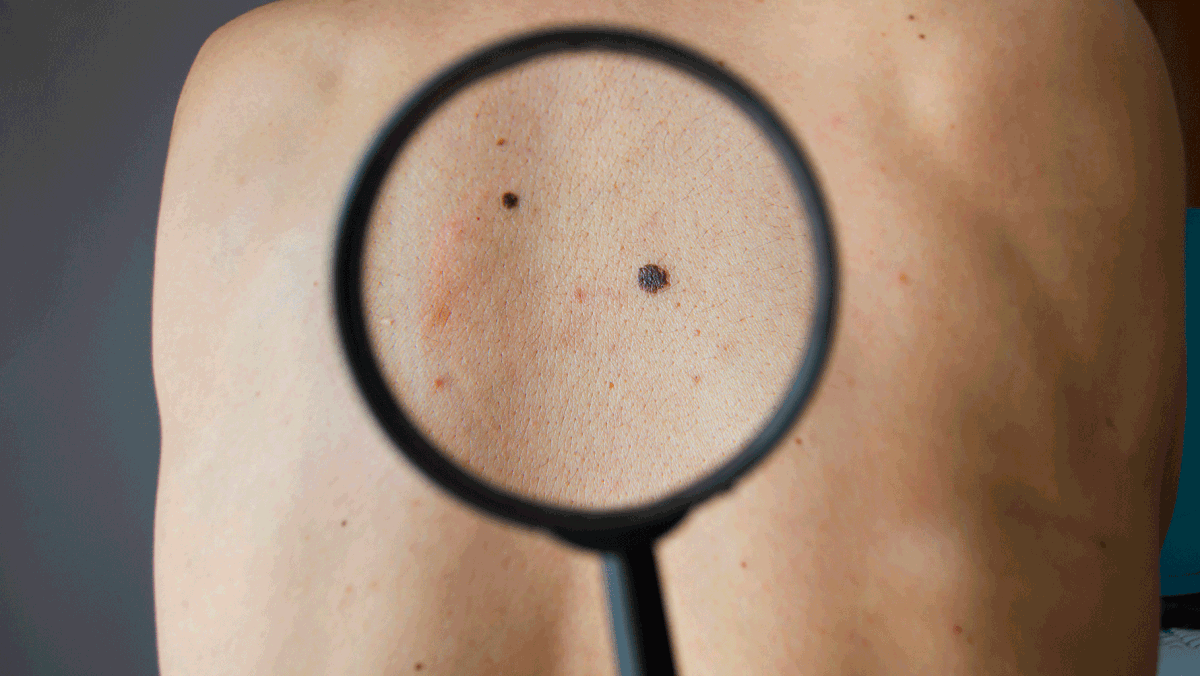 A new study has questioned the link between melanoma, the deadliest type of skin cancer &  the number of moles on you