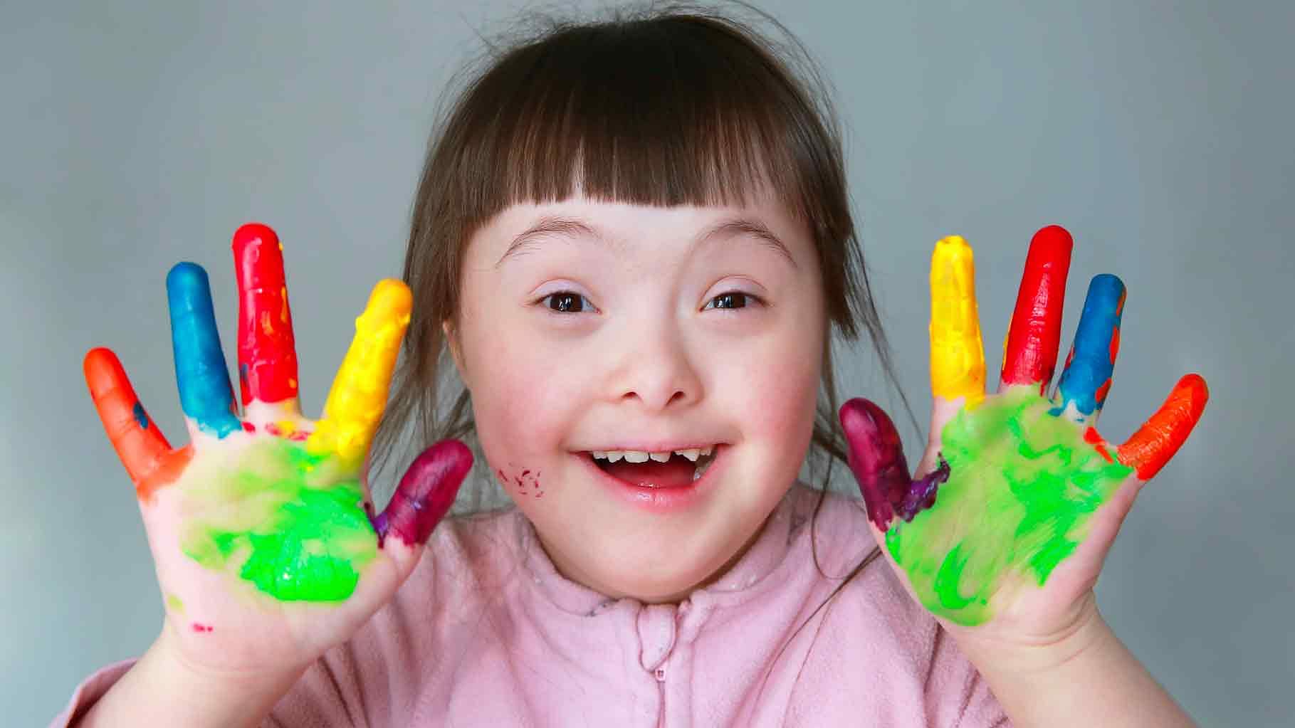 Down Syndrome (DS) is a genetic disorder that leads to mental retardation and abnormal physical growth.