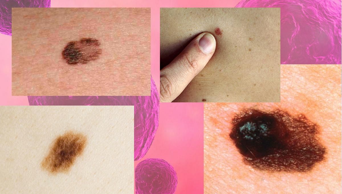 A new study has questioned the link between melanoma, the deadliest type of skin cancer &  the number of moles on you