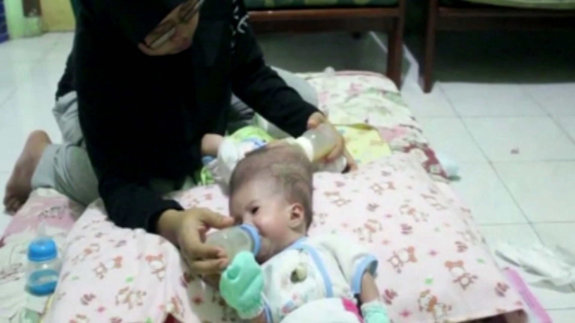 Four-month-old conjoined twins Nadira Alifa Putri and Nadiba Aisyah Putri were born on 21 January, 2016 at the Tanjungpinang Regional General Hospital in Indonesia. (Photo: AP/Caters News screengrab)