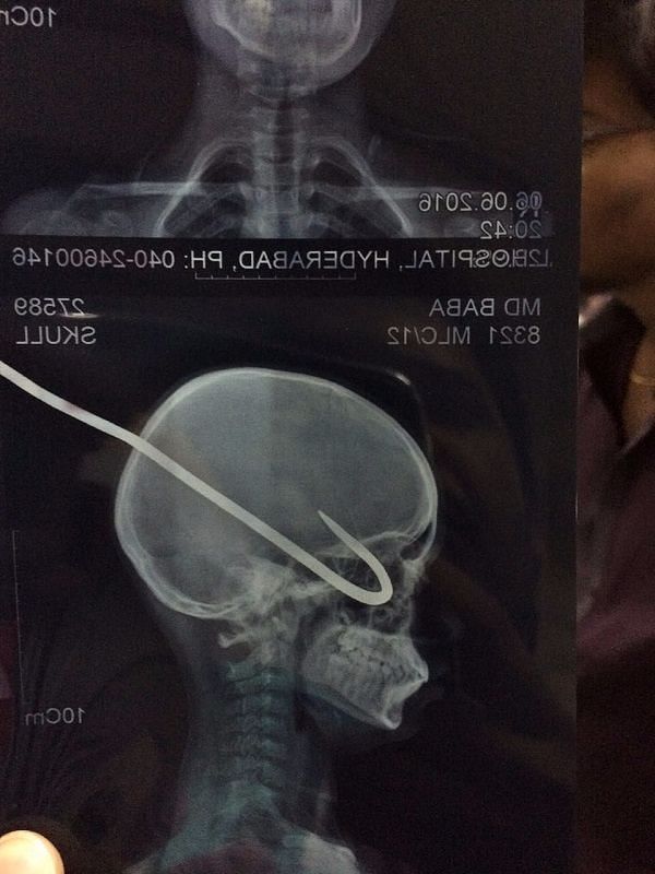 How a boy miraculously escaped when a mutton rod almost pierced his ear and brain. 