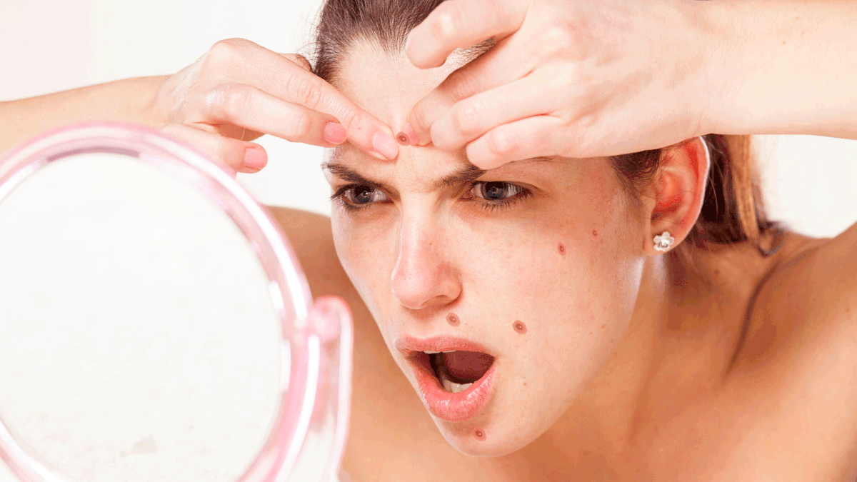 Warning: ‘Super Acne’ Is  Real, Rising and  Impossible To Treat!
