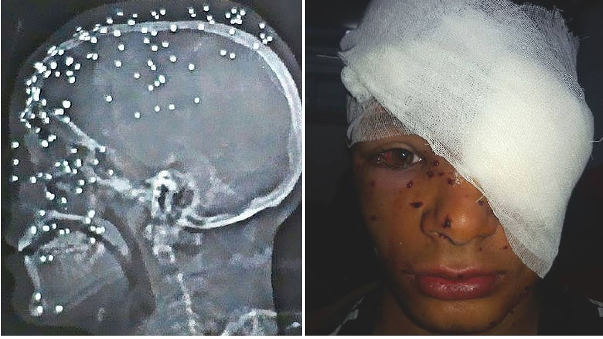 An X-ray showing pellet injuries to a skull (L). A class 10 student who was injured in March (R). The X-ray and the photograph are unrelated. (Photo Courtesy: Facebook/<a href="https://www.facebook.com/kashmirscarsofpelletgun/?fref=ts">Kashmir Scars of Pellet Gun</a>)