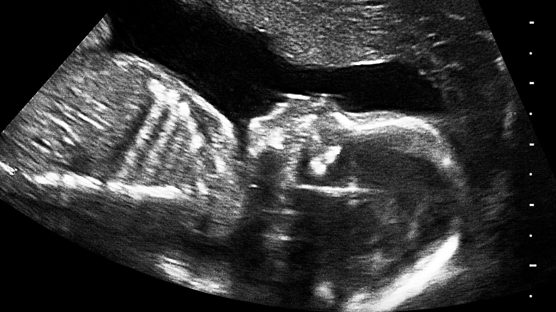 Photo of a foetus used for representational purposes.
