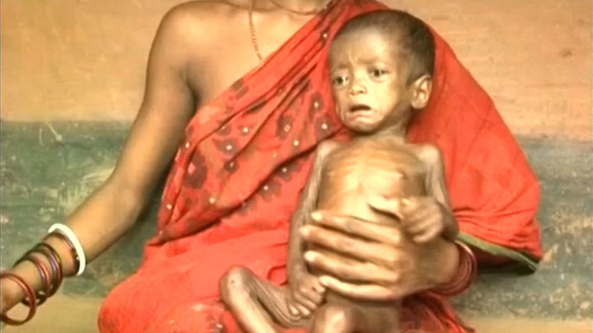 Representational Image: A malnourished infant in Nagada village in Odisha’s Jajpur district.(Photo: ANI screengrab)
