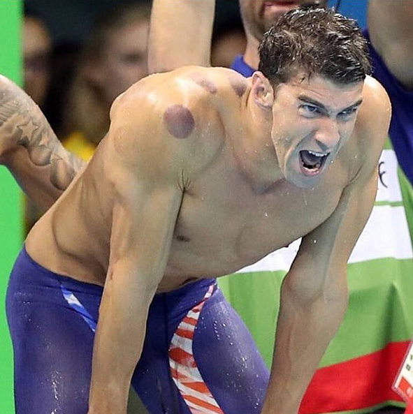 Michele Phelps with “cupping” marks. (Photo Courtesy: Instagram/<a href="https://www.instagram.com/p/BI2vRu_A5cI/?tagged=michaelphelps">weix105437</a>)
