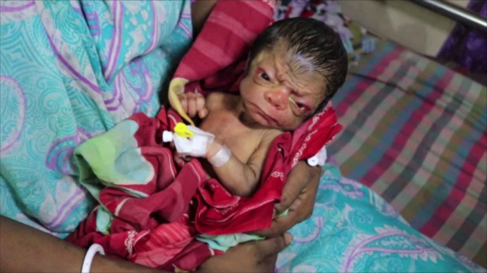 A baby born in Bangladesh who suffer from Progeria, a rare genetic disease.(Photo Courtesy: AP Screengrab)