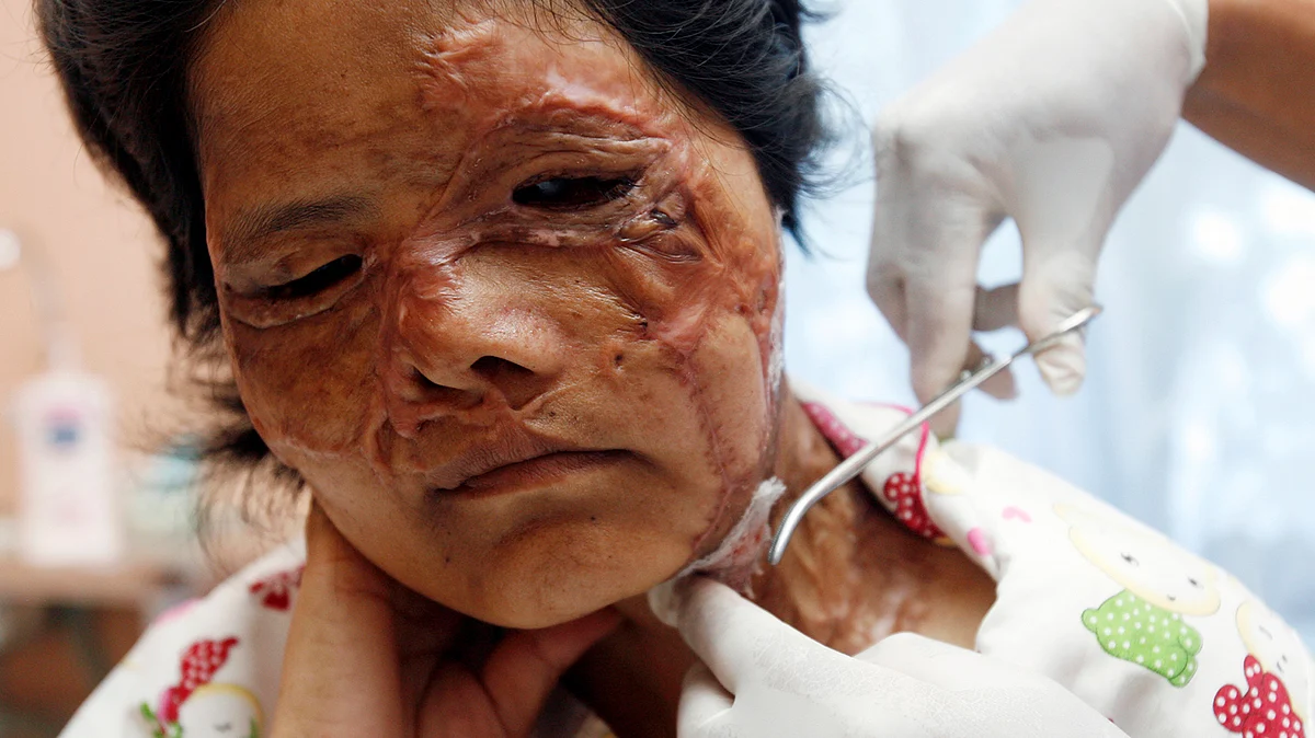 Due to the absence of a government resolution, hospitals don’t offer treatment to acid attack victims free of cost or even certify them handicapped. (Photo: Reuters)