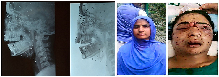 Pellets penetrated Insha Mallik’s head and face rupturing her right eye. (Photo: AFP/Factly)