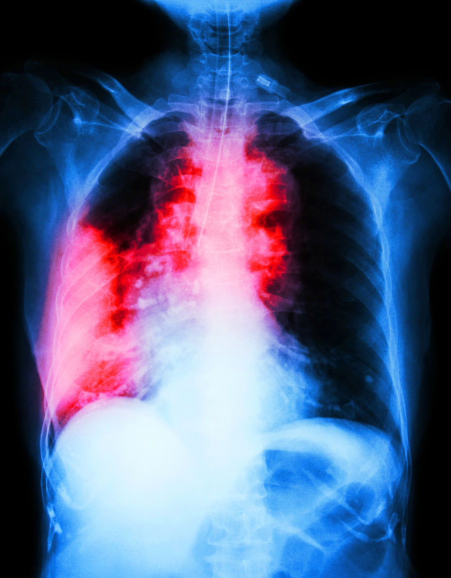 It’s no longer just the smokers, anyone with lungs is at risk of lung cancer.
