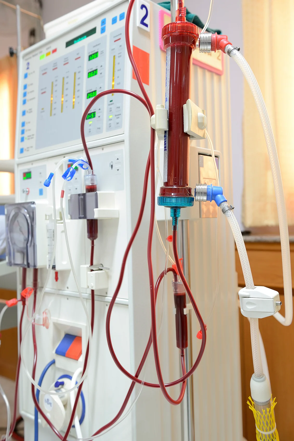 This is a dialysis machine, it imitates the kidneys and patients on dialysis begin to feel better quickly but being chained to a machine to stay alive means that simple things like working full time, travelling become limited. (Photo: iStock)