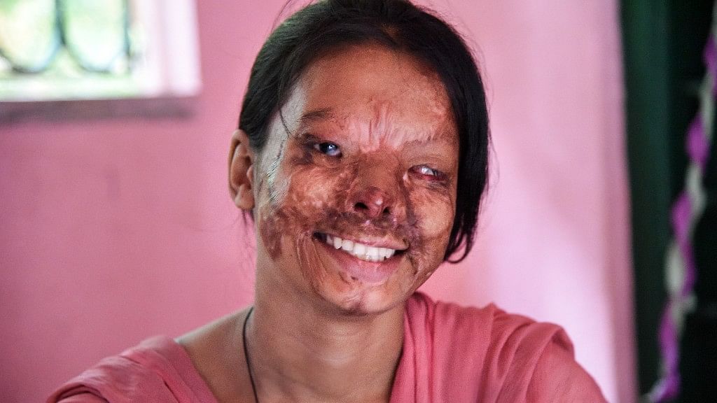 

“I believe that they only burnt my skin but not my self-confidence. I’m trying to get into a post-graduation course. I will soon get a job and show them,” says Manisha. (Photo courtesy: Tanmoy Bhaduri)