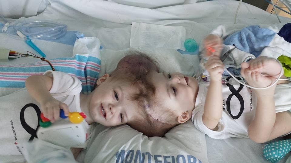 The twins were suffering from a rare condition called Craniopagus. (Photo Courtesy: Facebook/<a href="https://www.facebook.com/photo.php?fbid=10101962429213232&amp;set=pb.31100589.-2207520000.1481548617.&amp;type=3&amp;theater">Nicole McDonald</a>)