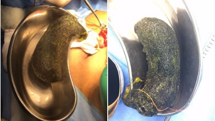 A girl with hair accumulated in her stomach was operated upon on Wednesday. (Photo Courtesy: The News Minute)