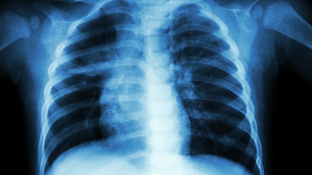 Bedaquiline, the ‘miracle’ drug, seems to be the only medication that could cure this 18-year-old girl’s tuberculosis. (Photo: iStock)