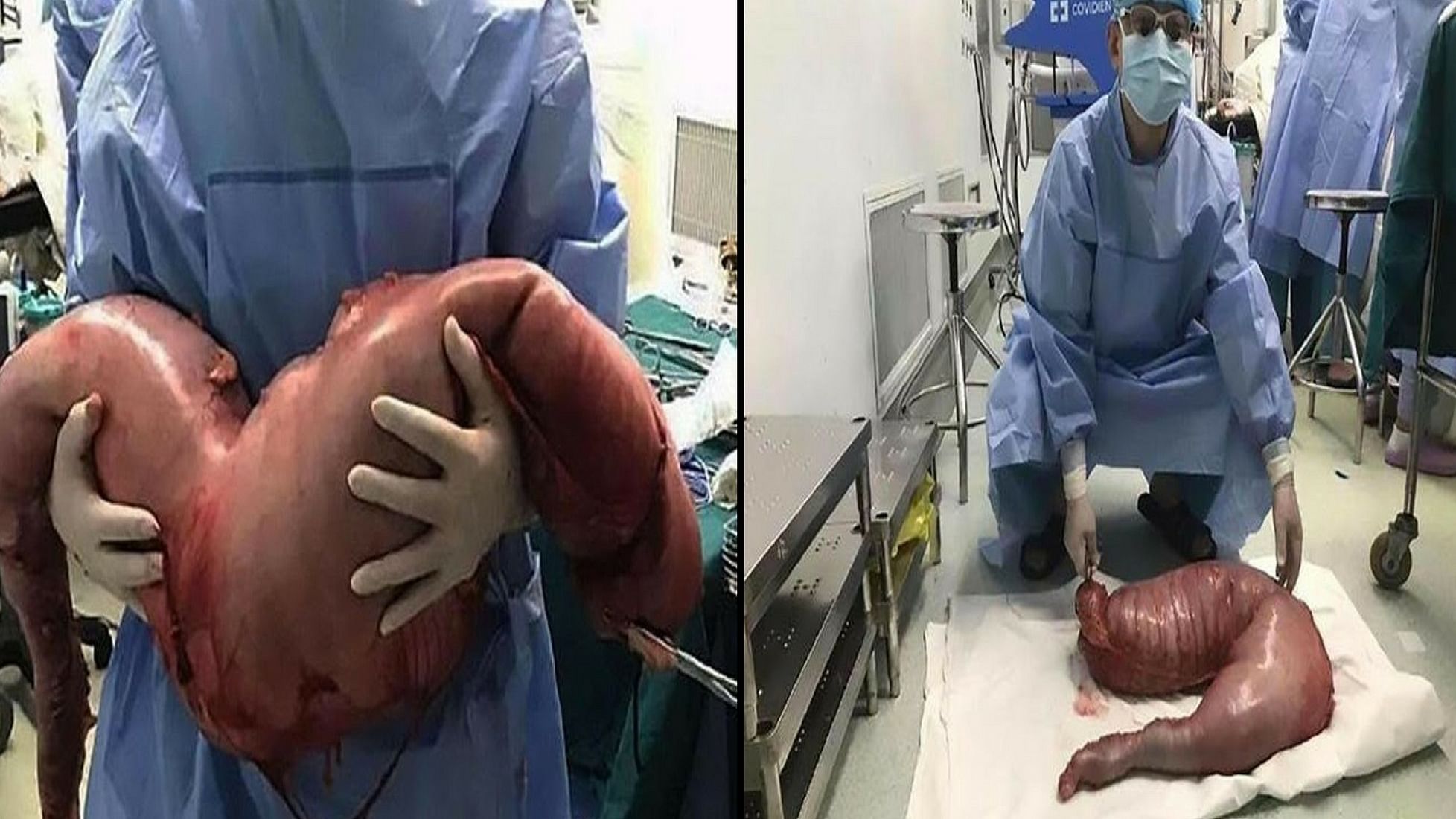 A man constipated for 22 years gets 13 kg of poop surgically removed in China. (Photo: <a href="https://www.inverse.com/article/32839-constipated-man-china-feces-poop-hirschsprung-disease">Inverse</a>)&nbsp;