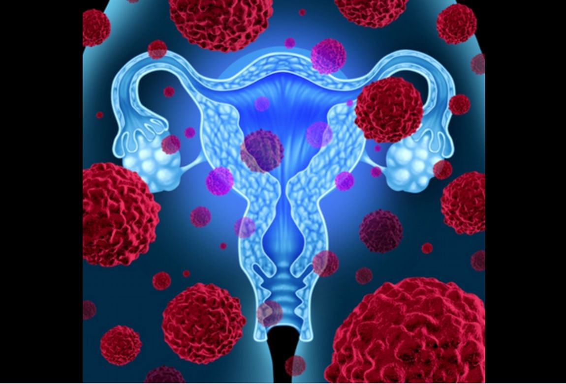 Ovarian cancer usually begins in the ovaries of the female reproductive system.