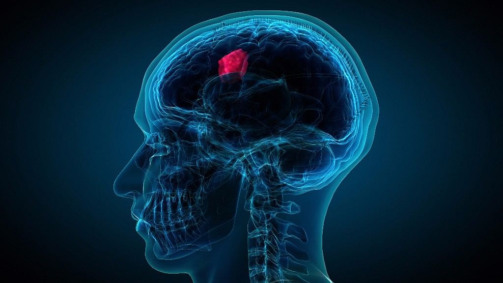 Here are some things to know about glioblastoma, a malignant brain tumour.