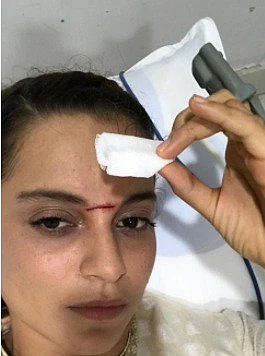 Kangana shows her injured forehead. 