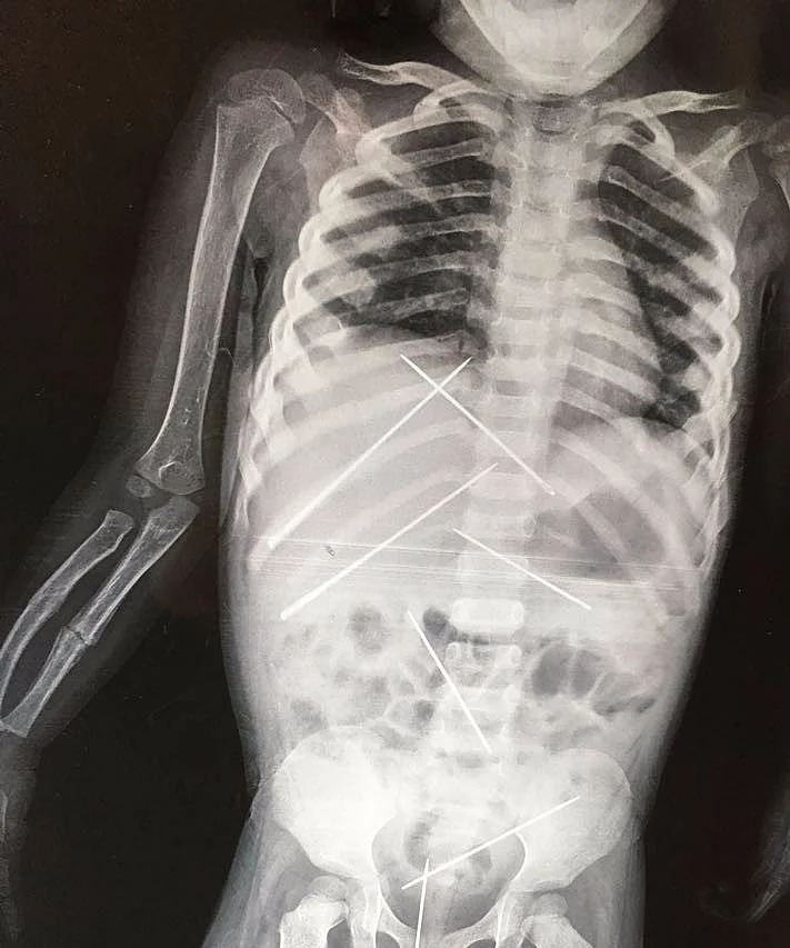 X-ray of the three-year-old shows needles inside her body.