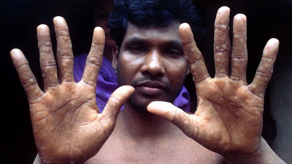 

File photo of a Bangladeshi man showing wound on his hands after drinking water from an arsenic affected tubewell.