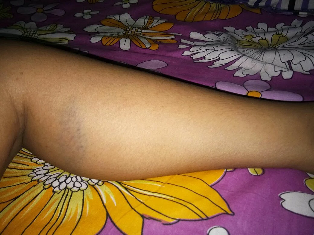 Bruises on Shubhangi’s legs.