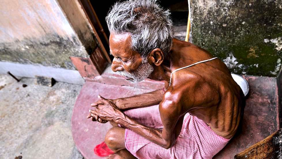 Fluorosis has crippled 68-year-old Himanshu Chakarbarty, a resident of high fluoride-affected Brahman Tola in Dhanbad district.&nbsp;