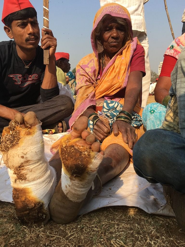Shikkubai Wagle has her feed bandaged due to blisters after walking 180 kms.