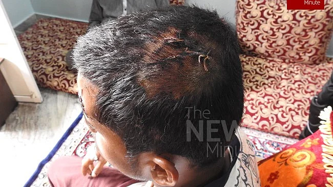 Salman had to receive stitches on his head.